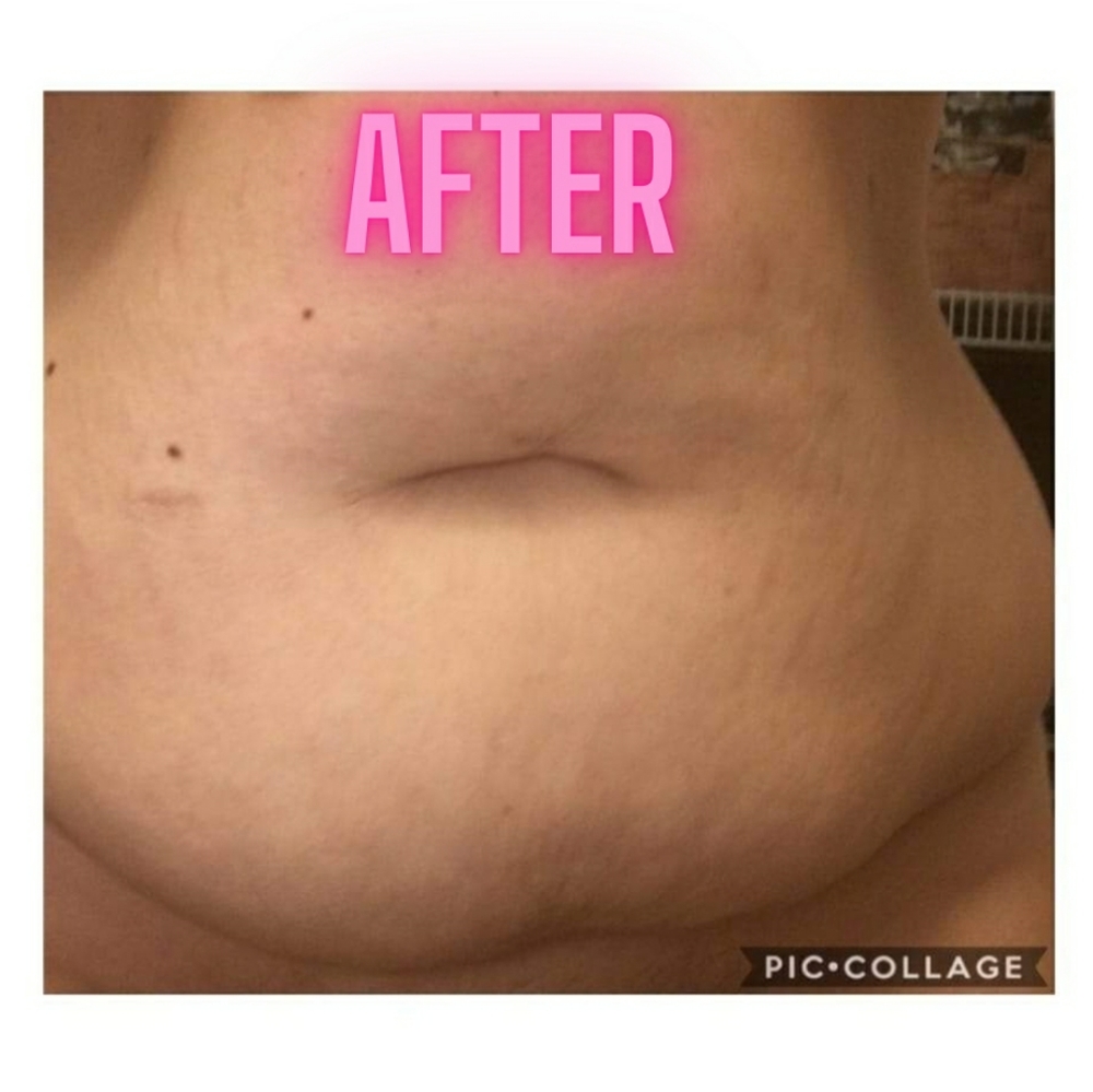 PREORDER ONLY ByeBye Stretch Marks,Mosquitos,Burns - Picture 4 of 16